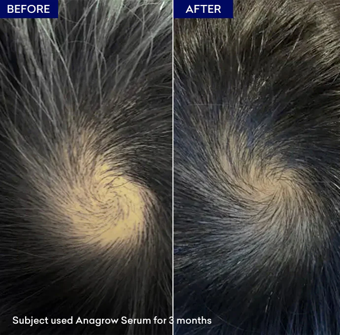 Anagrow Hair Serum - Image 4