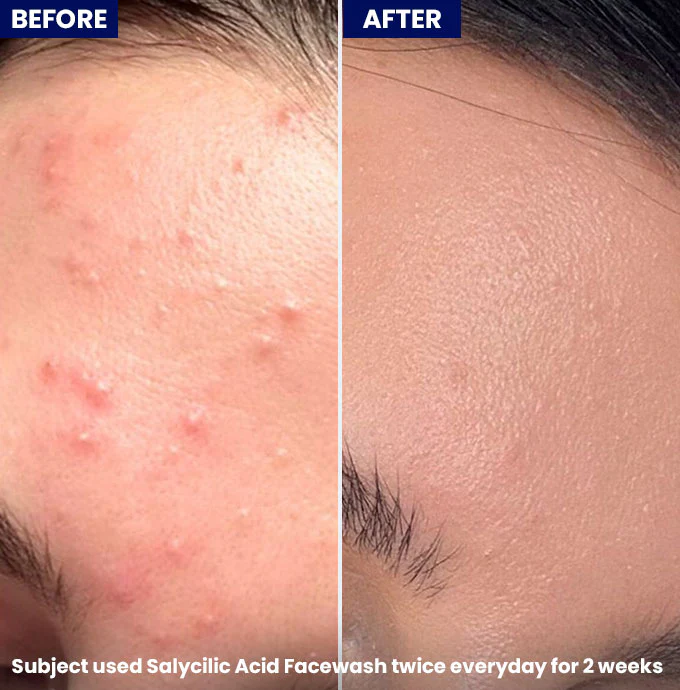 Clarevo Salicylic Acid Facewash - Image 3