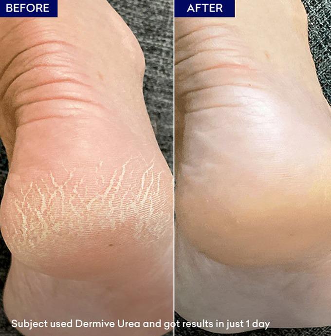 Dermive Urea Economy Pack - Image 4