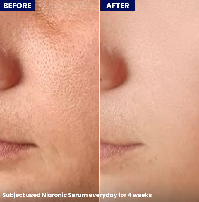 NiaRonic Serum (Pore Minimizing) - Image 4